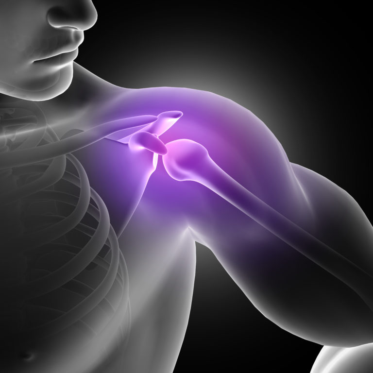 Scopri di più sull'articolo Protesi di spalla